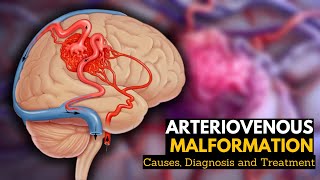 Arteriovenous Malformation Causes Signs and Symptoms Diagnosis and Treatment [upl. by Reivazx]