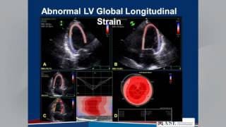 Echocardiographic Assessment of LV Diastolic Function Webinar [upl. by Petersen47]