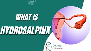 WHAT IS HYDROSALPINX [upl. by Rehpotsirahc]