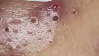 Blackheads amp Whiteheads Satisfying Removal 0104 [upl. by Ydnolem]