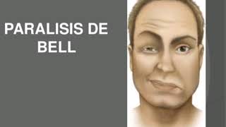 Parálisis de Bell  Parálisis facial TERAPIA [upl. by Eilyac500]