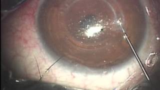 Extrusion of Intracorneal ring segment 3 years post implantation [upl. by Ellivro391]