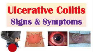 Ulcerative Colitis Signs and Symptoms amp Why They Occur and Complications [upl. by Ane]