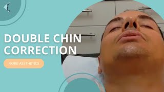 PDO threadlift double chin correction [upl. by Renaxela]