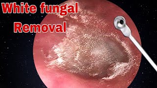 Ear Wax amp White Fungal Removal  Doctor Anh [upl. by Bhayani]