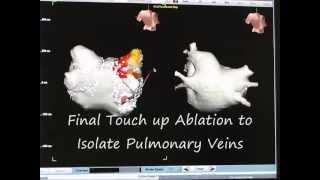 Atrial Fibrillation Ablation part 3 of 3 How to Perform Pulmonary Vein Isolation [upl. by Ahcsas]