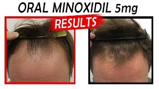 CRAZY Oral Minoxidil Before and After Results Episode 2 [upl. by Vento278]