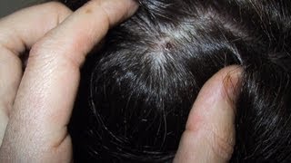 How to Treat a Dry Scalp DermTVcom Epi 482 [upl. by Cornelia758]