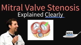 Mitral Valve Stenosis Explained Clearly  Pathophysiology Symptoms Treatment [upl. by Asir]