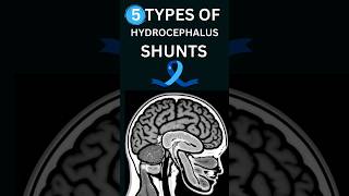 🧠 types of HYDROCEPHALUS shunts [upl. by Auqenet]