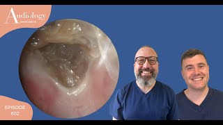 SKIN ENCASED EAR WAX PLUG REMOVAL EP802 [upl. by Ahsita413]