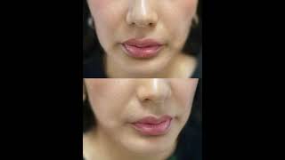 Facelift amp face lipofilling facelift uzbekistan beautiful узбекистан [upl. by Tedra]