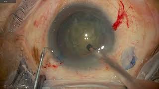 Clip  33 4K Toric IOL and soft cataract management [upl. by Ilegna]