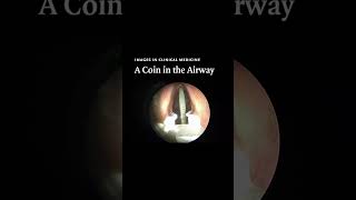 NEJM Images in Clinical Medicine A Coin in the Airway [upl. by Navarro]