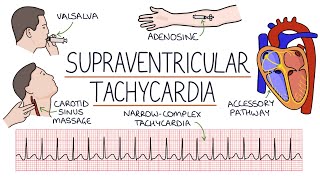 Understanding Supraventricular Tachycardia SVT [upl. by Joelie]