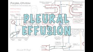 Pleural Effusion DETAILED  pathophysiology signs and symptoms treatment [upl. by Oiredised]