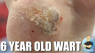 REMOVING A 6 YEAR OLD HUGE THICK PLANTAR WART [upl. by Susan]