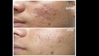 Treating a Juvenile Acne Breakout  1 [upl. by Estas]