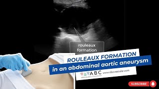 VASCULAR ULTRASOUND Rouleaux formation in an abdominal aortic aneurysm [upl. by Savick885]