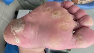 Warts remove calluses [upl. by Ahsika]