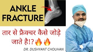 Ankle Fracture Treatment💥🔥 तार से फ्रैक्चर कैसे जोड़ते हैं⁉️K Wiring Foot [upl. by Tnafni54]