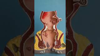 Hemorrhoids I Fissure I Fistula I Hernia I Treatment in India [upl. by Anifad17]