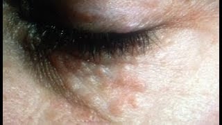 Syringoma removal naturally FAST at home  My Experiment w Transformation Results [upl. by Aenea882]