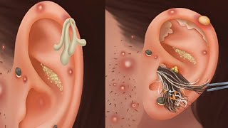 ASMR Treatment Of Badly infacted Ear  Ear Cleaning ASMR  Ear wax Removal [upl. by Richmal255]