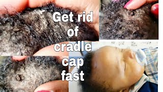 Cradle cap treatment  Cradle cap in babies [upl. by Vogele]