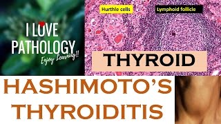 HASHIMOTOS THYROIDITIS Etiopathogenesis Morphology amp Complications [upl. by Oned70]