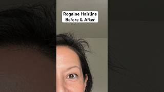 Rogaine Foam Hairline Before And After 💁🏻‍♀️ Minoxidil For Women [upl. by Anauqat]