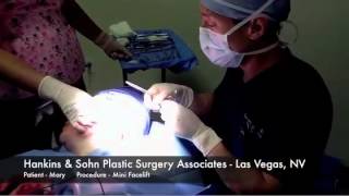 Mini Facelift Surgey Las Vegas  Hankins amp Sohn Plastic Surgery Associates [upl. by Voss]