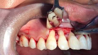 Cirugía periodontal regenerativa con Emdogain y preservación de papila [upl. by Nnyleahs]