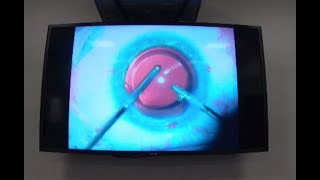 RLE eye surgery on HG pilot [upl. by Bronder]