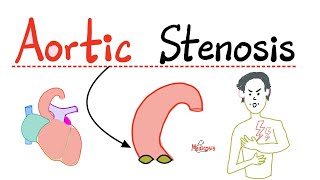 Aortic Stenosis AS  Valvular Heart Disease VHD  Causes Symptoms Diagnosis Treatment Cardio [upl. by Buote]