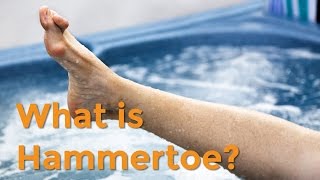 To Your Health Quick Takes What is Hammertoe [upl. by Arayt]