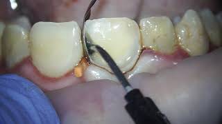 replacing a filling on the front central incisor  filling on a front tooth dentist teeth cavity [upl. by Aliak292]