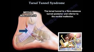 Tarsal Tunnel Syndrome  Everything You Need To Know  Dr Nabil Ebraheim [upl. by Lehcor37]