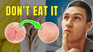 Top 5 Foods to Remove if you Have Psoriasis [upl. by Yentihw786]