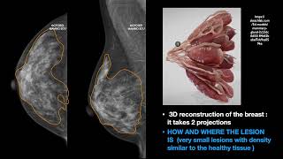 THE MAMMOGRAPHY FINDINGS PART ONE HOW AND WHERE [upl. by Adrienne]