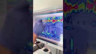 Esophageal Manometry Test with Austin Gastro November 2024 [upl. by Ranchod]