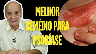 QUAL O MELHOR REMÉDIO PARA PSORÍASE  SAIBA [upl. by Tristis]