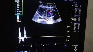 Reversal of End diastolic flow in MCA [upl. by Aihsenor500]