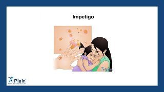 Impetigo [upl. by Narrad]