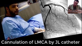 Left coronary system angiographic cannulation by JL catheterDr Alaa Nasr2019 [upl. by Ronnie]