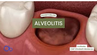 Alveolitis  qué es síntomas y tratamiento [upl. by Ilse]