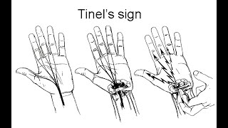 Tinels Sign Clinical Test Definition Procedure Meaning Positive Negative Associated condition [upl. by Neyud]