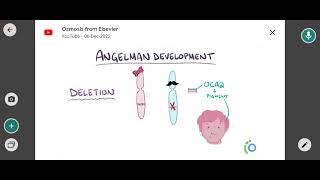 angelman syndrome [upl. by Ymrots]