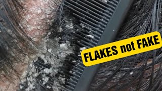 Psoriasis FLAKES [upl. by Haig919]