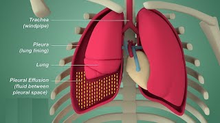 Differentiating pleural vs pericardial effusion by anatomy on echo [upl. by Alaine252]